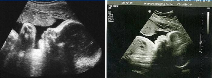 Échographie de l'abdomen à 34 semaines de gestation