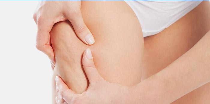 Cellulite sur les jambes