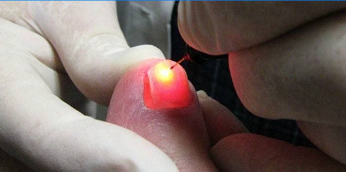 Procédure de retrait des ongles au laser