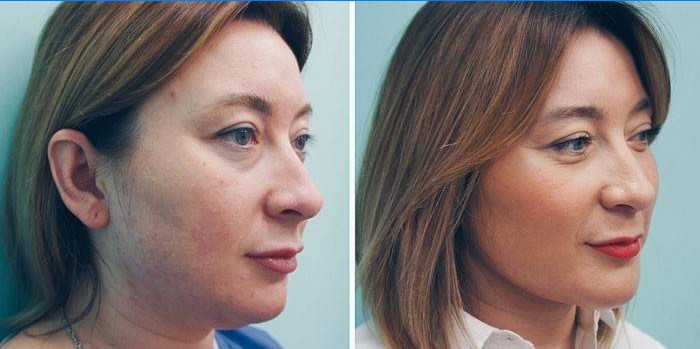 Femme avant et après les injections lipolytiques