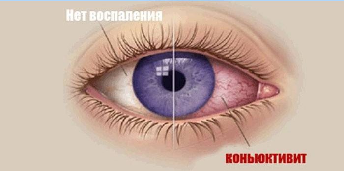 Conjonctivite oculaire