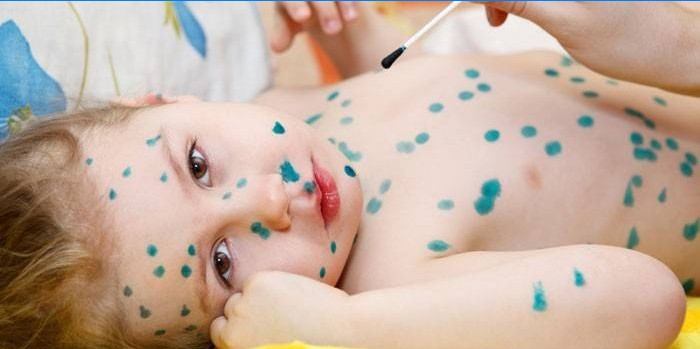 L'enfant a la varicelle