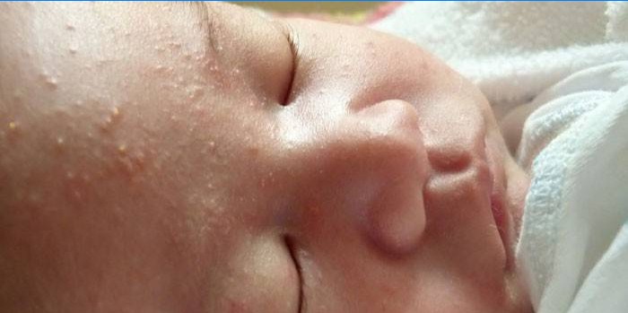 Manifestations d'une éruption cutanée néonatale sur le visage d'un enfant