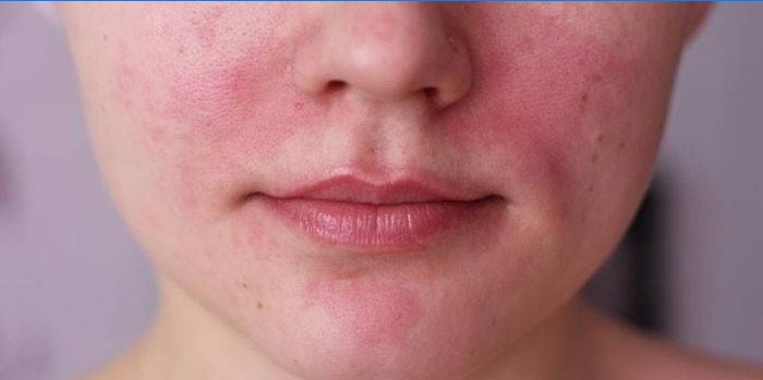 La manifestation d'une allergie sur le visage