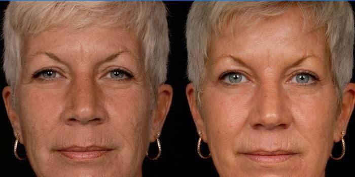 Photo d'une femme avant et après la carboxythérapie