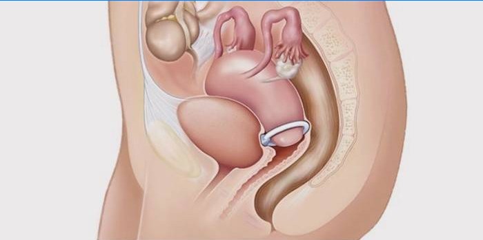 Pessaire cervical