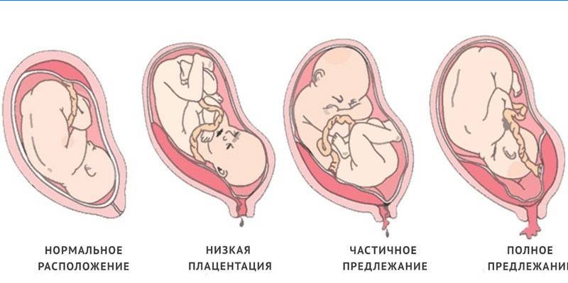 Types de placenta previa