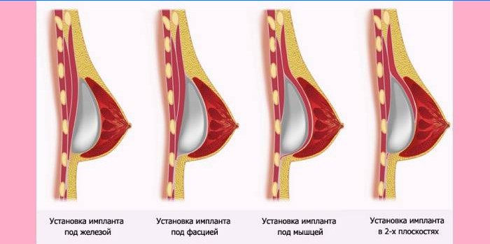 Méthodes d'installation des implants mammaires