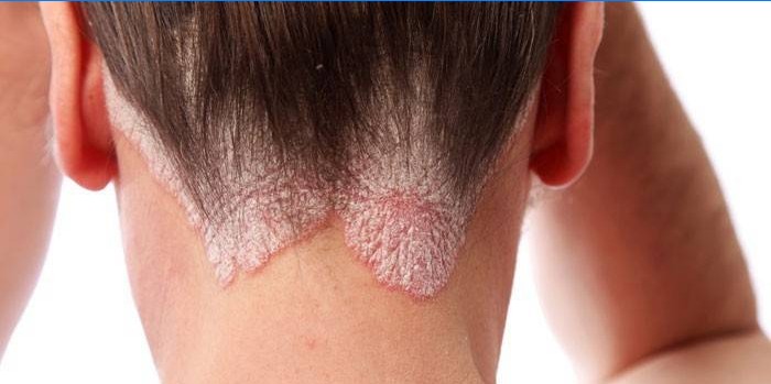 Psoriasis du cuir chevelu