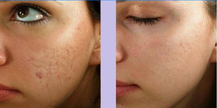 Visage de femme avant et après le massage