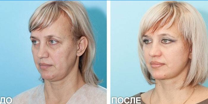 Photo d'une femme avant et après le levage SMAS