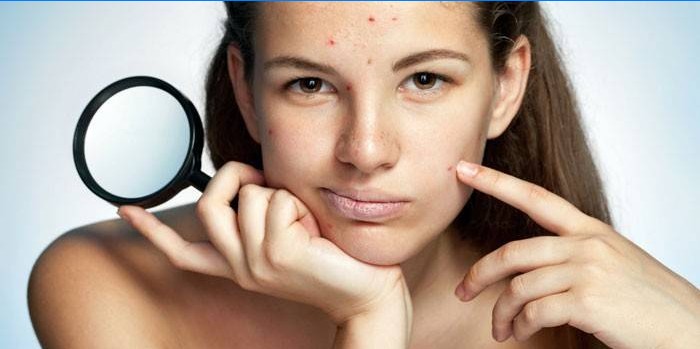 La fille a de l'acné sur le visage