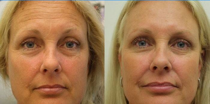 Visage de femme avant et après levée SMAS