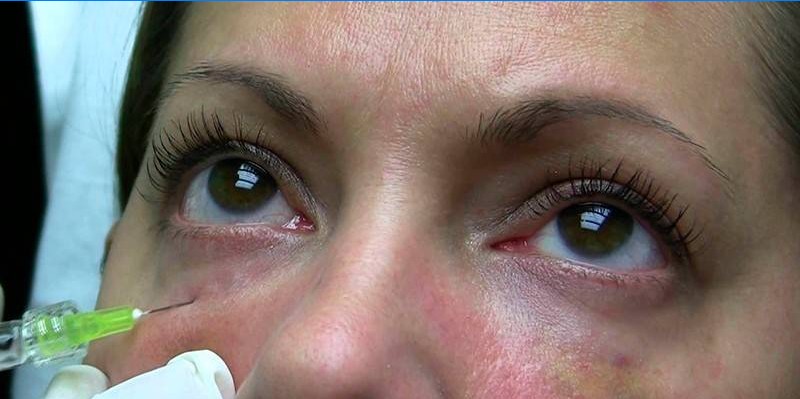 Une femme reçoit une injection sous les yeux