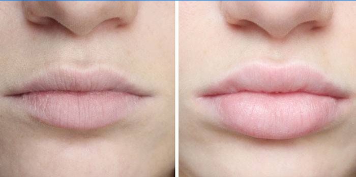 Acide hyaluronique sur les lèvres avant et après