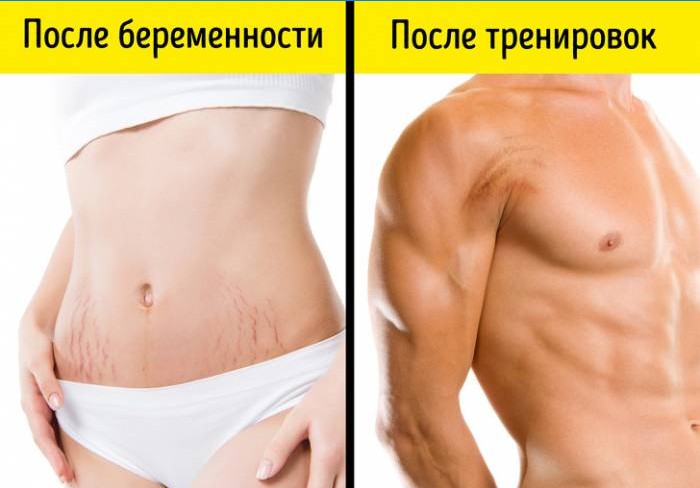 Vergetures sur les corps féminins et masculins