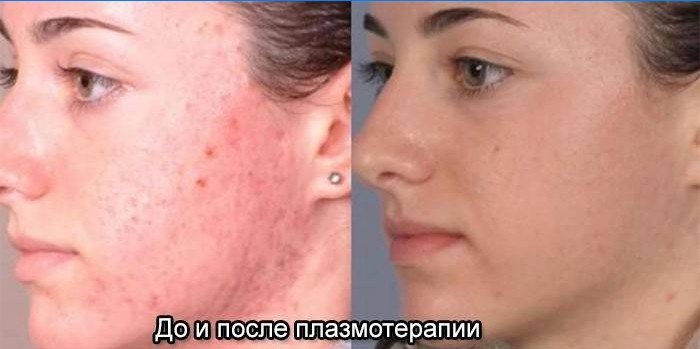 Peau du visage avant et après thérapie plasmatique