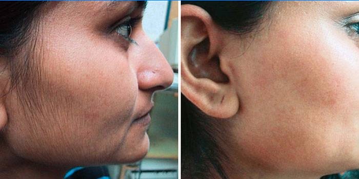 Épilation au laser sur le visage: photos avant et après