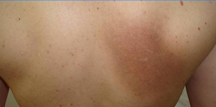 Melasma